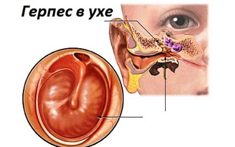 Причины, разновидности и методы лечения герпеса в ухе Ушной герпес симптомы и лечение у взрослых