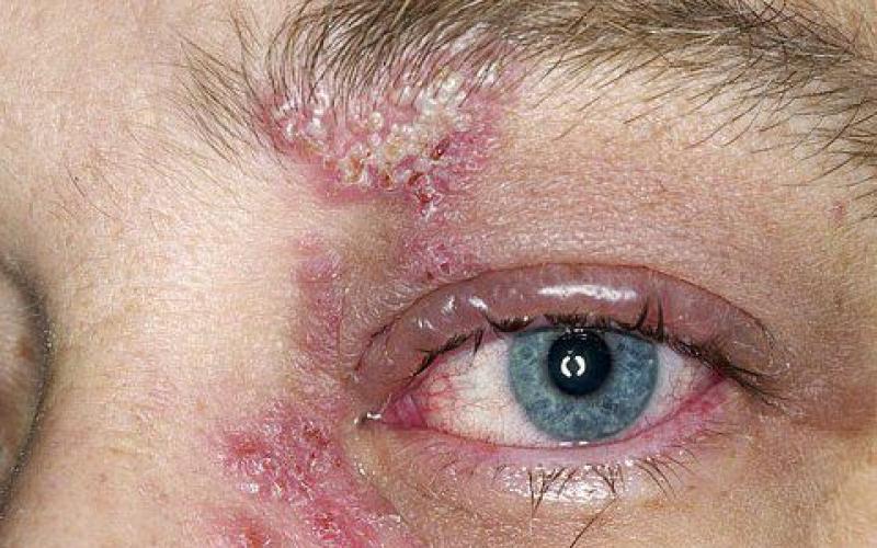 Герпес на глазах - вирусное заболевание с опасными последствиями Как вылечить герпес на глазах навсегда