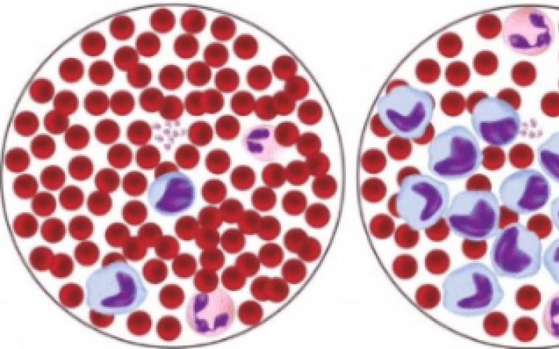Тромбоцитопения при вич Закономерности в общем анализе крови у ВИЧ-инфицированных