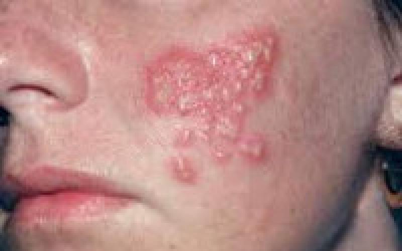 Симптомы всех типов герпесвируса и сопутствующих заболеваний